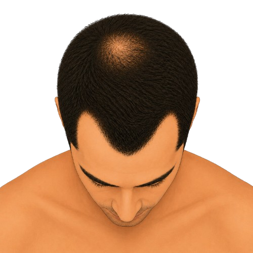 Stage 3 Vertex – top view